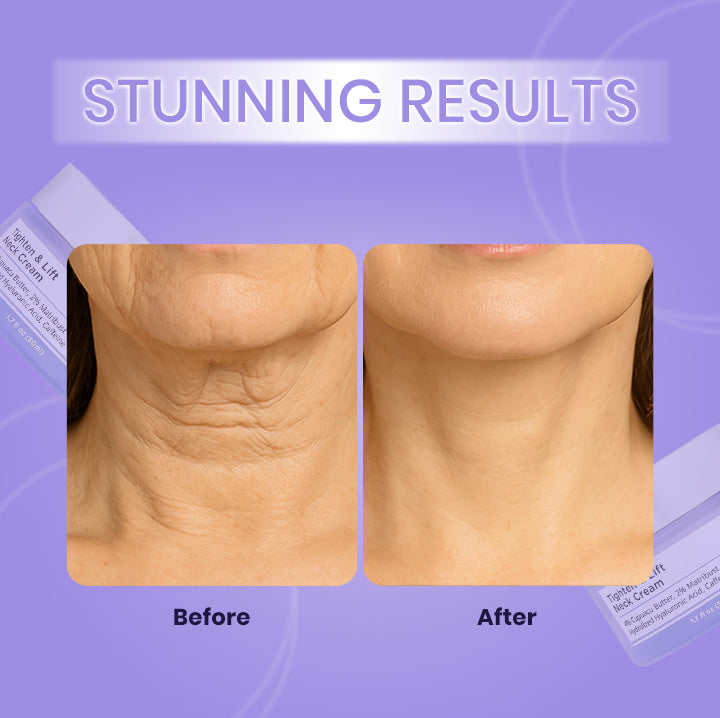 Before and after comparison of neck skin texture on a purple background with 'Stunning Results' text.